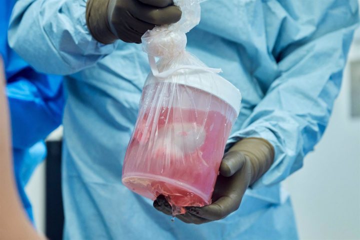 El trasplantado ha conseguido la mayor sobrevida y podría ser el paso previo a la generalización de la transferencia de órganos entre animales mutados y humanos