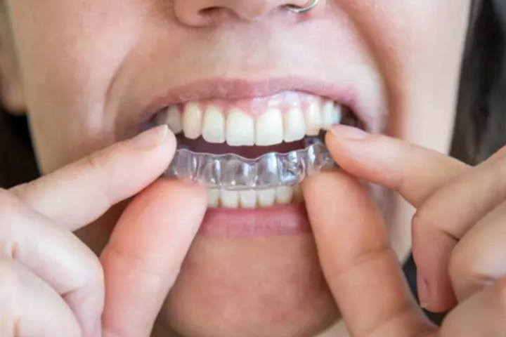 férulas dentales férulas dentales dientes fundas