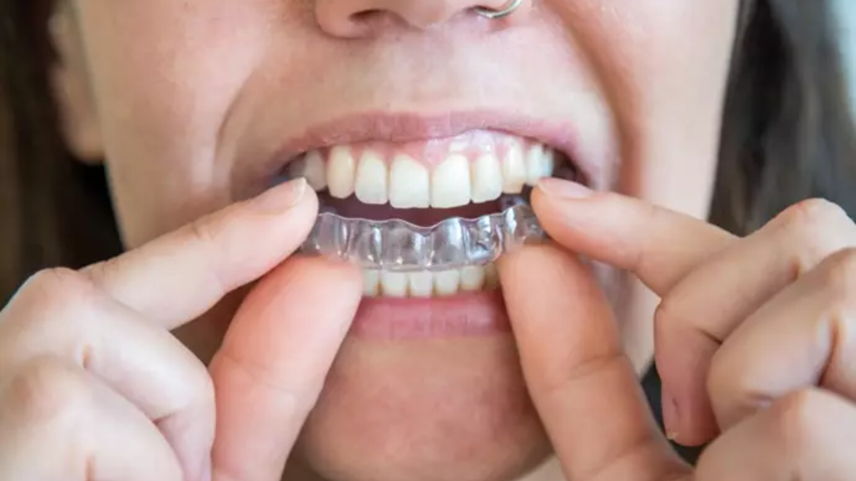 férulas dentales férulas dentales dientes fundas