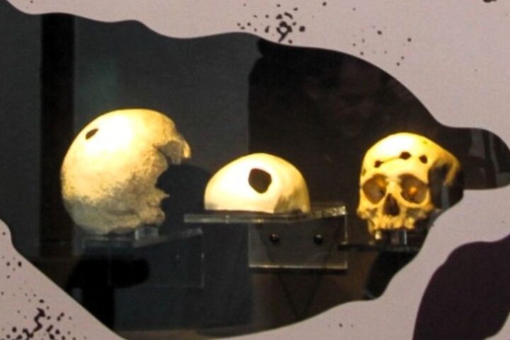 Cráneos humanos trepanados o cómo llegar al interior del cerebro